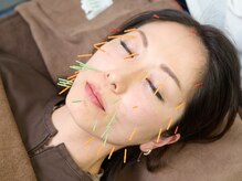 諏訪の杜鍼灸院/美容鍼