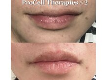 月香館/プロセル肌質改善