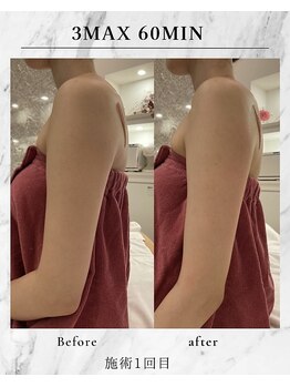 ラズリ(Lazuli)/3max 60min 二の腕ver