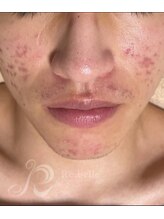 リン 長崎 大村(Rin)/before