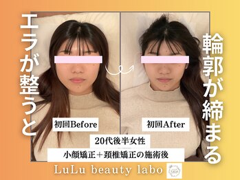 ルルラボ(LuLu beauty labo)/エラ改善で締まる輪郭