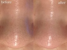 アワピール 天王寺店(AWA PEELL)/毛穴洗浄/天王寺/毛穴洗浄/小顔