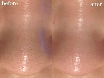 アワピール 天王寺店(AWA PEELL)/毛穴洗浄/天王寺/毛穴洗浄/小顔