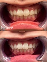 ディオーネ 自由が丘(Dione)/ホワイトニング【20代 3照射 】