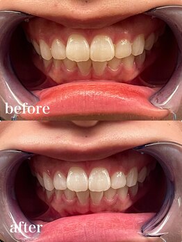 ディオーネ 自由が丘(Dione)/ホワイトニング【20代 3照射 】