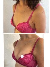 サロンツキ(salon tuki)/【バストアップ】症例★