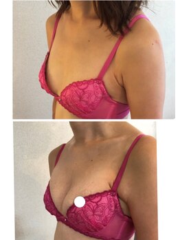 サロンツキ(salon tuki)/【バストアップ】症例★