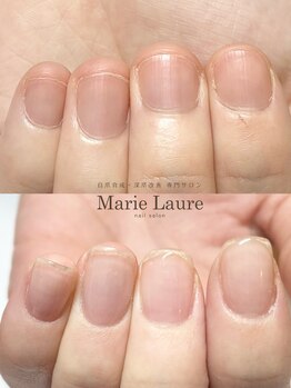 マリーロール 梅田店(Marie Laure)/自爪育成/深爪矯正/ネイルケア