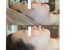 グランヴェルジェ(Granverger)/陶肌トリートメント6回