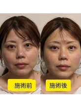プレシャスワン 越谷店/美容鍼　ビフォーアフター