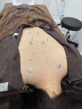 鍼灸院 快笑(cocoroe)/鍼灸施術リピート増加中！！