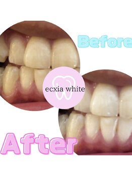 エクシアホワイトニング 仙台駅東口店/ホワイトニングビフォーアフター