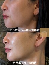 レミュー(remiu)/表情筋テラボーラー5回