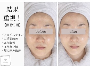 サロン ド パーフェクション(Salon de Perfection)/小顔リフト