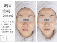 サロン ド パーフェクション(Salon de Perfection)/小顔リフト