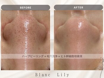 ブランリリー 福岡薬院店(Blanc Lily)の写真/薬院大通駅から徒歩4分のハーブピーリング専門サロン♪毛穴レスな美肌を手に入れてみませんか？