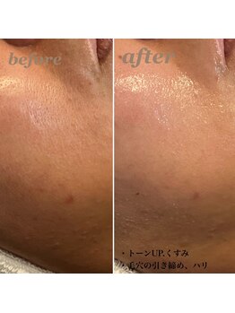 ディア(DIA)/【毛穴ケア・ザラつき解消】