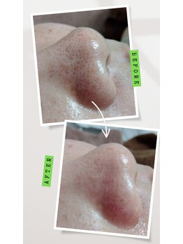 ルアナ(Luana)/美容液毛穴洗浄でツルツル肌に♪