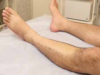 グラティアス(Gratias.)/膝下脱毛~施術後~