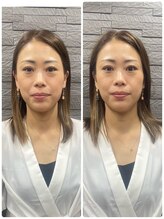 長寿鍼灸院 長寿整骨院/美容鍼50本の効果★小顔効果