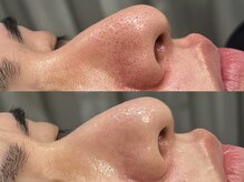 オパール 大阪梅田(op_l)/毛穴の黒ずみビフォーアフター