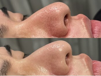 オパール 大阪梅田(op_l)/毛穴の黒ずみビフォーアフター