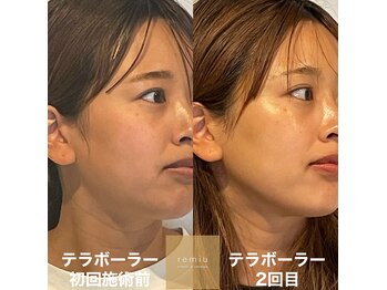 レミュー(remiu)/表情筋テラボーラー2回