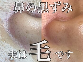 GLITTER泉中央店　 脱毛/毛穴/小顔/シミケア/痩身/もみほぐし/肩こりの写真/《フェイシャルWax脱毛》頑固な毛穴詰まりもスッキリ解消。触れたくなるようなツルスベ肌へ導きます！