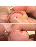＼NEW／巻き爪矯正ジェル＋ワンカラー☆¥10,000