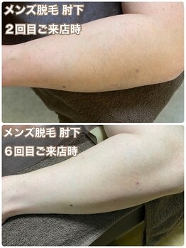 ゼロ 水戸店(ZERO)/腕脱毛★before&after