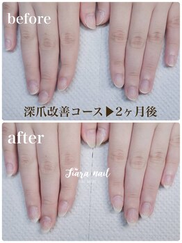 ティアラネイル 宇都宮/リプロネイル深爪矯正コース