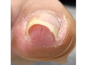 両側も一回で矯正できます