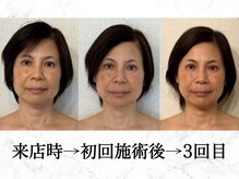 コノハナ(conohana)/ 来店時→初回施術後→3回目