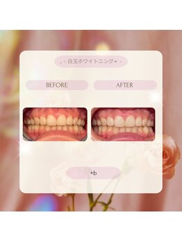 プラスビー 2号店(+b)/ホワイトニングビフォーアフター