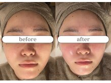 リスタ(RSTA)/【BEFORE/AFTER】