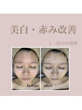 エステティック レイビス 新宿店(RAYVIS)/★水光ピーリング★