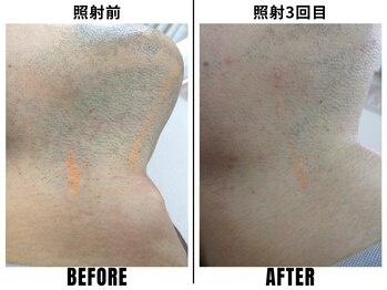 ストック 立花店(STOCK)/【ヒゲ】首脱毛1回→3回目