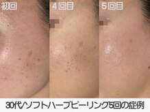 ラ コケット(La Coquette)/定期的に続けて肌質改善したい