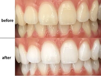 メルヴェイユ/東中野ホワイトニング