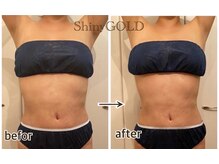 シャイニーゴールド 新所沢店(Shiny GOLD)/1回でも驚きの引き締め効果◎