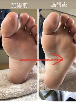 ラリベルテ(La liberte)/～足裏角質ケア～