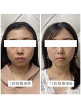 ヴィーライン 恵比寿本院(VeLine)/お客様Before After/小顔効果