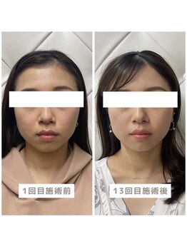 ヴィーライン 恵比寿本院(VeLine)/お客様Before After/小顔効果