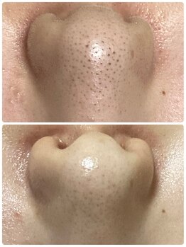 ザ フェース 東京目黒店(THE FAITH)/イチゴ鼻ケア