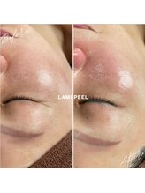 トータルビューティサロン リボーテ(Re:Beaute)/ラミネーションピール