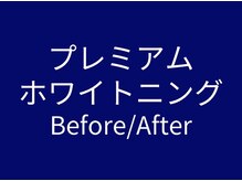 ホワイトニングカフェ 立川店(WhiteningCafe)/◎ホワイトニング効果