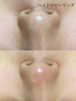 サロンドフルール/ハイドロピーリング