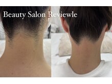 レビュール(Reviewle)/うなじWAX＋光脱毛