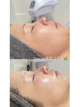 クレヴィー(Creviy)/Special美肌コース