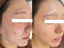 ビスキン(BeSkin)/ハーブピーリング/毛穴ケア